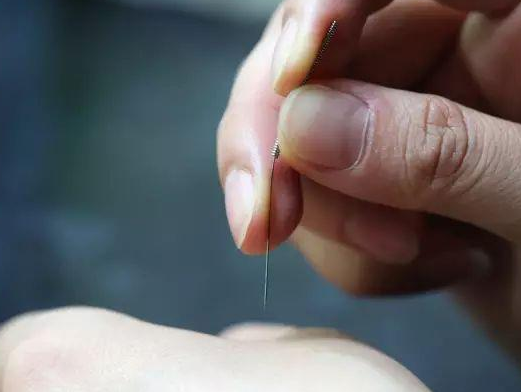 三棱針療法治療高燒嗎？